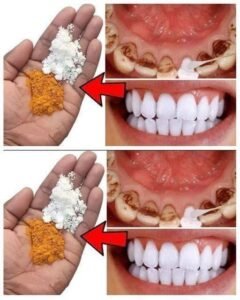 😳 Dentists Warn: Be Careful With “2-Minute Teeth Whitening” Hacks Going Viral Online ⚠️🦷