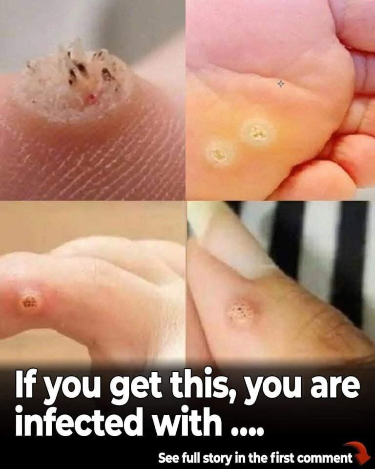 6 Types of Warts (Signs, Symptoms, Home Remedies, and Treatment)…