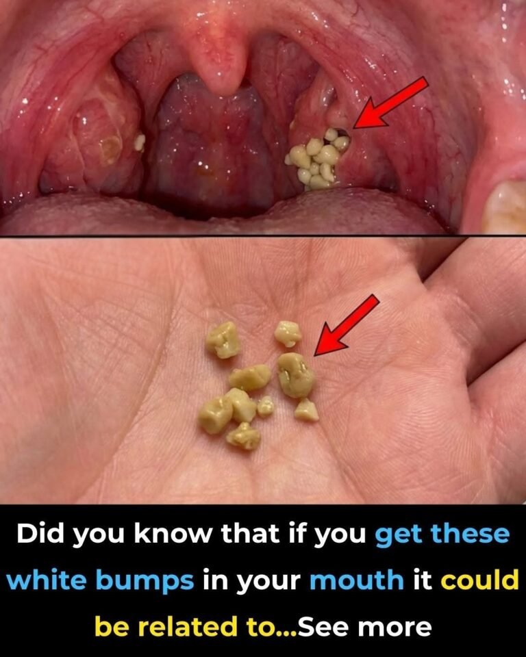 Tonsil Stones: Discover what they are, how they appear, and how to get rid of them forever..: