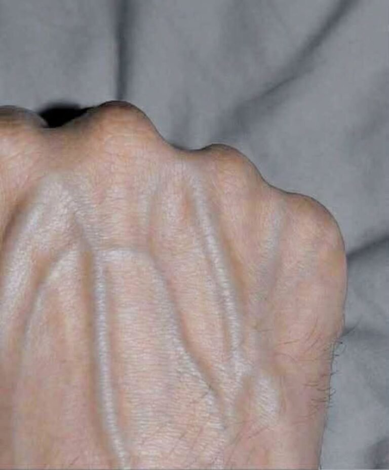 If Your Hand Veins Are Bulging or More Noticeable, Don’t Ignore These Possible Causes