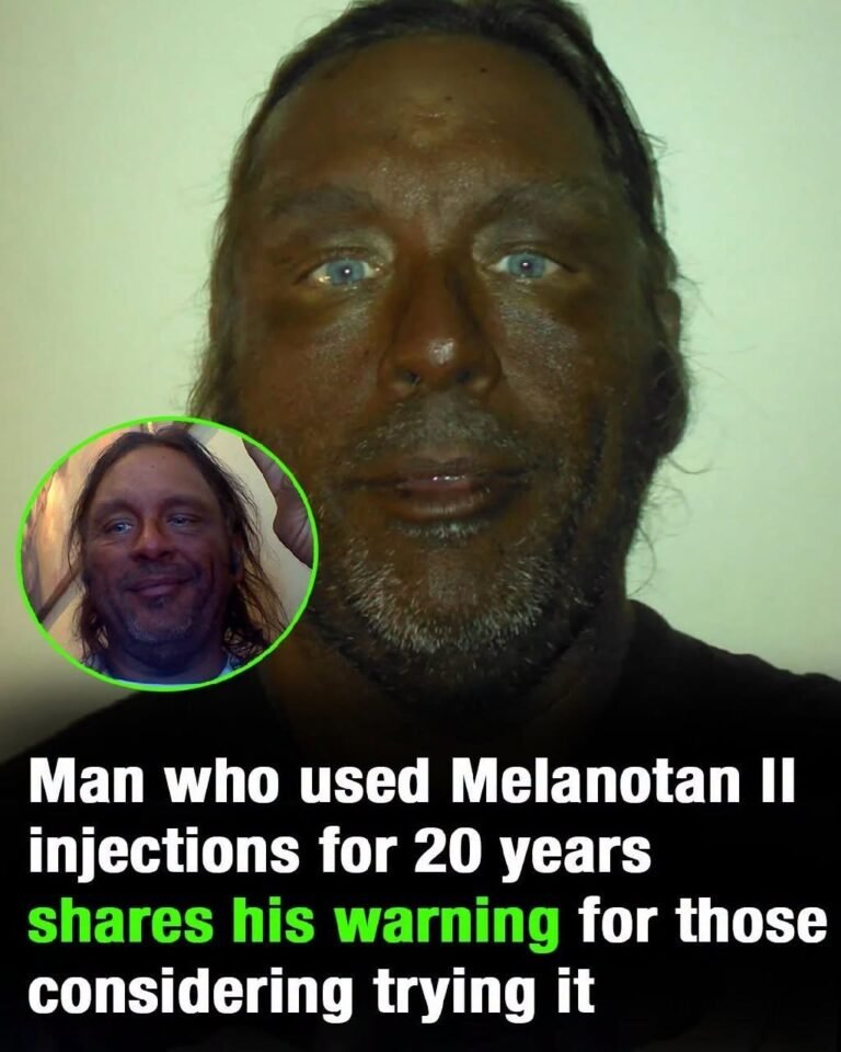 Man who used Melanotan II injections for 20 years shares his warning