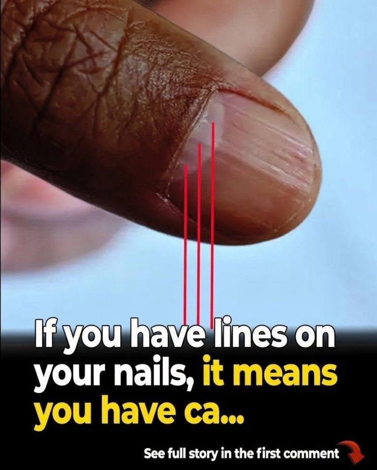 Lines on your nails may indicate nutritional deficiencies or other health issues.