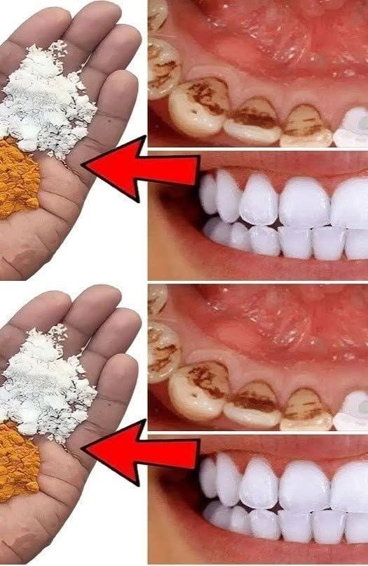 How to Whiten Your Teeth at Home in Just 1 Minute for a Naturally Brighter Smile