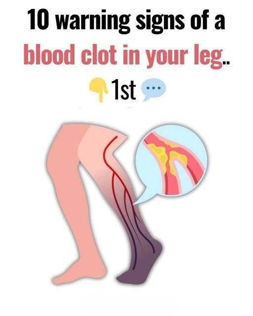 10 Warning Signs of a Blood Clot in the Leg You Should Know