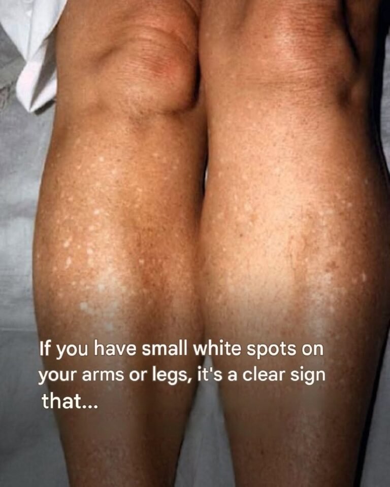 Why do I get white spots on my skin in the summer and how can I treat them? A dermatologist answers.