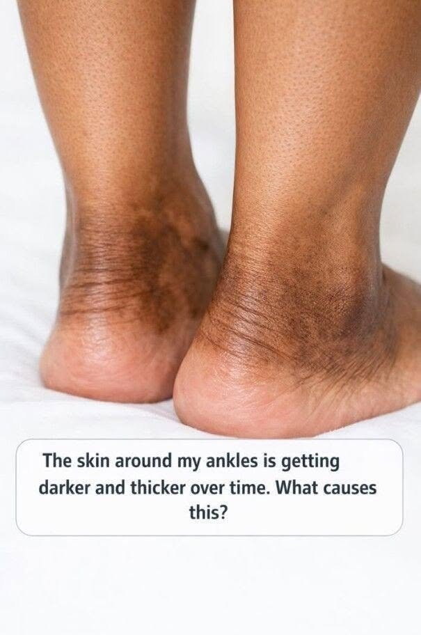 The skin around my ankles is getting darker and thicker over time. What causes this?