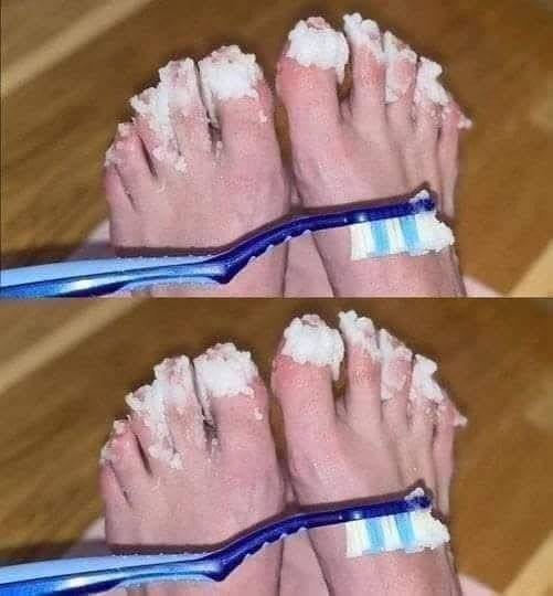 Natural Remedy for Nail Fungus: Effective Treatment for Quick Relief